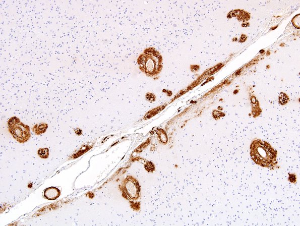 7D1 Congophilic Angiopathy (Case 7) N5 Bamyloid 2