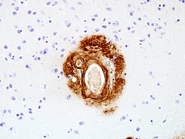 7D2 Congophilic Angiopathy (Case 7) N5 Bamyloid 1