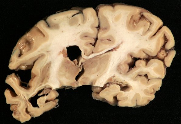 8A1 AD (Case 8) & Leukoaraiosis_1