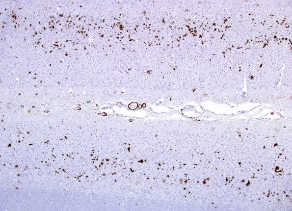 8C2 CAA, Dyshorric (Case 8) N4 Bamyloid 4