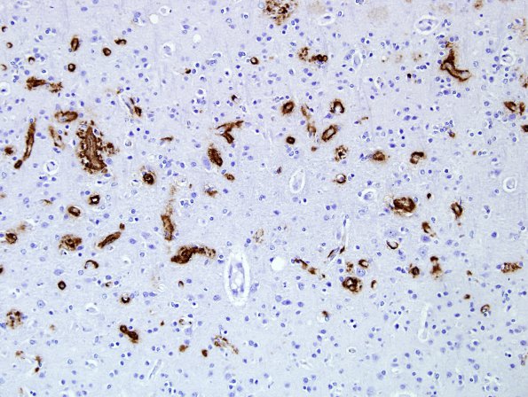 8C3 CAA, Dyshorric (Case 8) N4 Bamyloid 2