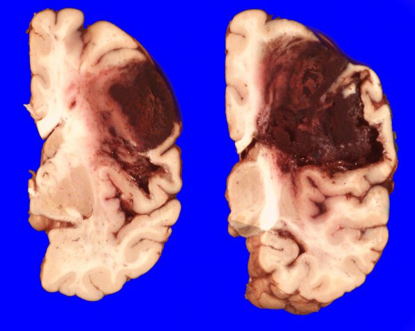 9A2 CAA, hemorrhage (Case 9) 3