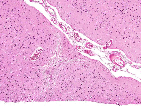 9B1 CAA, hemorrhage (Case 9) H&E 6