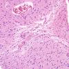 9B2 CAA, hemorrhage (Case 9) H&E 7