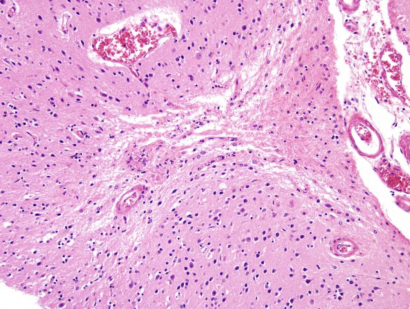 9B2 CAA, hemorrhage (Case 9) H&E 7