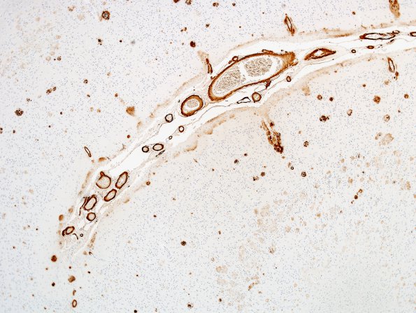 9C2 CAA, hemorrhage (Case 9) BAmyloid 4