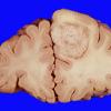 10A1 Metastases (Case 10)