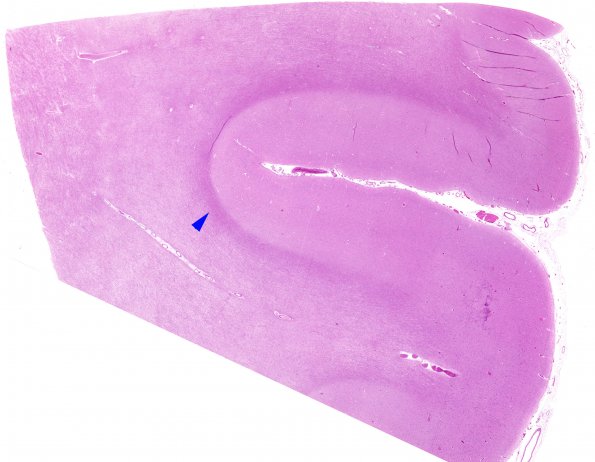 10B1 Edema, Chronic (Case 10) Frontal lobe metastasis 1 H&E whole mount copy