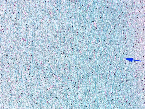 10C2 Edema, Chronic (Case 10) Frontal lobe metastasis LFB-PAS 1 copy