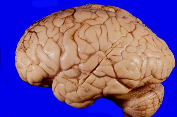 1A1 Edema (Case 1) 1