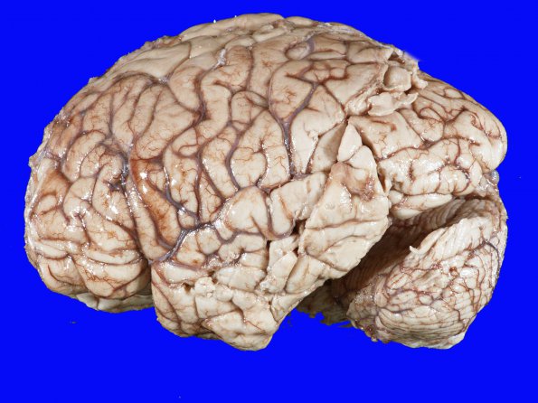 2A1 Edema, Hypoxia-Ischemia, adult, (Case 2) gross_2