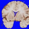 2A2 Edema (Case 2) 1 copy