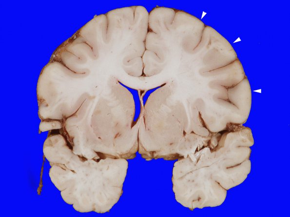 2A2 Edema (Case 2) 1 copy