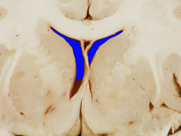 2A3 Edema (Case 2) 2