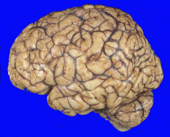 3A1 Edema (Case 3) 1