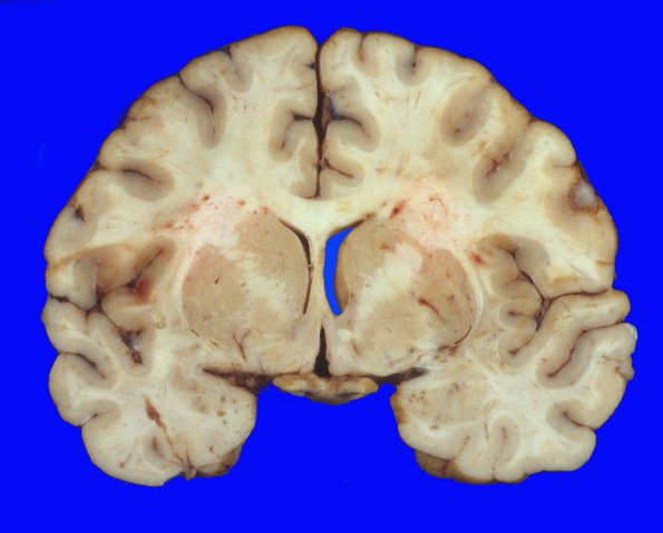 3A2 Edema (Case 3) 2