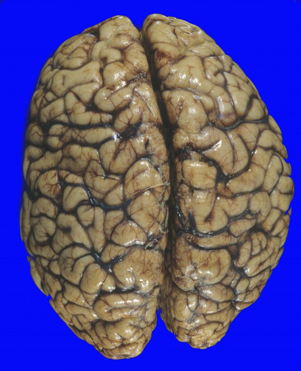 4A1 Trauma, MVA, contusions & DAI (Case 4) 15