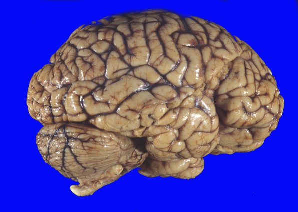 4A2 Trauma, MVA, contusions & DAI (Case 4) 13