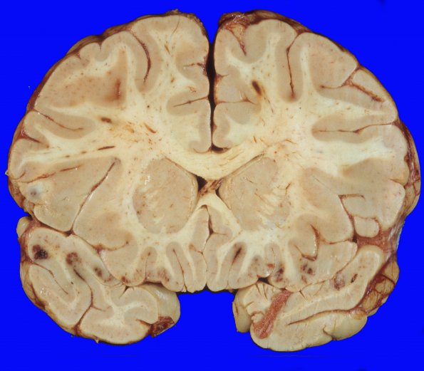 4A3 Trauma, MVA, contusions & DAI (Case 4) 18