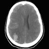 6A1 Edema (Case 6) CT 1 - Copy