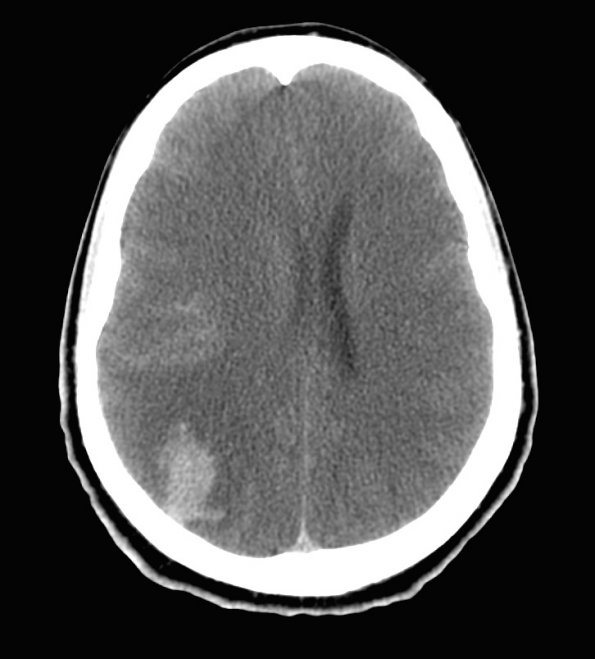 6A1 Edema (Case 6) CT 1 - Copy