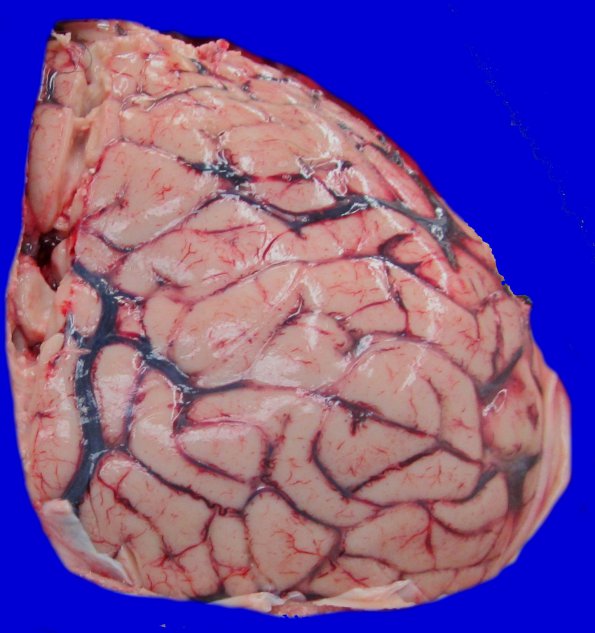 6B1 Rathke & Edema (Case 6)_1