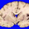 6B2 Rathke & Edema (Case 6)_3