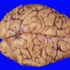 8A1 Edema secondary to Hypoxia-Ischemia (Case 8) 2