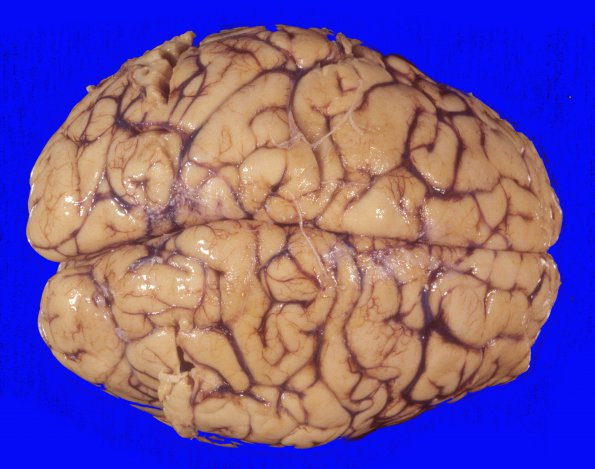 8A1 Edema secondary to Hypoxia-Ischemia (Case 8) 2