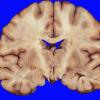 8A2 Edema secondary to Hypoxia-Ischemia (Case 8) 1