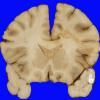 9A1 Edema secondary to Hypoxia-Ischemia (Case 9) 3