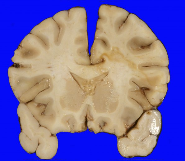 9A1 Edema secondary to Hypoxia-Ischemia (Case 9) 3