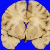 9A2 Edema secondary to Hypoxia-Ischemia (Case 9) 1