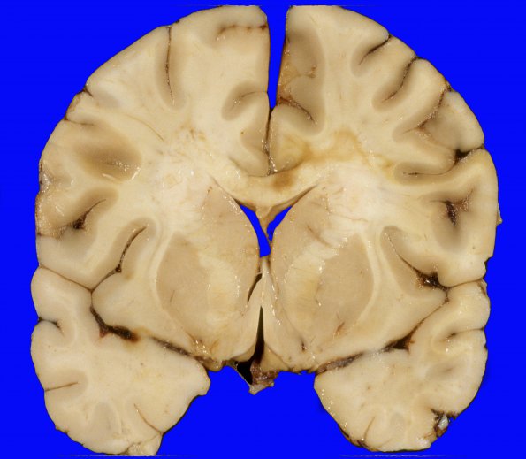 9A2 Edema secondary to Hypoxia-Ischemia (Case 9) 1