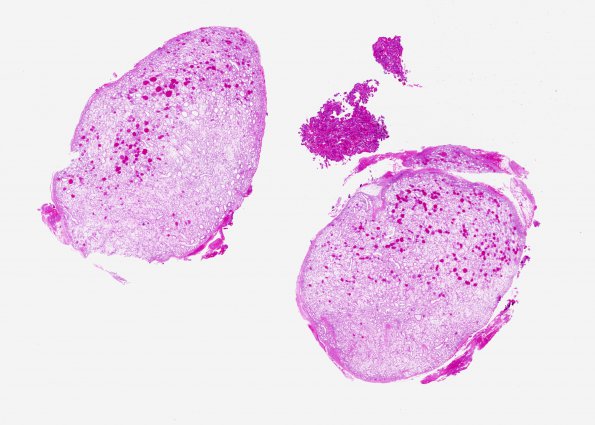 10A1 Hemangioma, capillary (Case 10) H&E WM