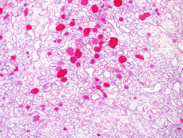 10A2 Hemangioma, capillary (Case 10) H&E 4