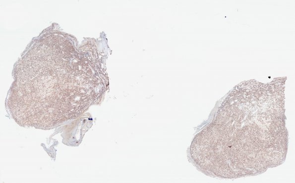 10B1 Hemangioma, capillary (Case 10) CD34 WM