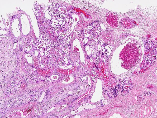 11A1 Hemangioma, capillary (Case 11) H&E 2