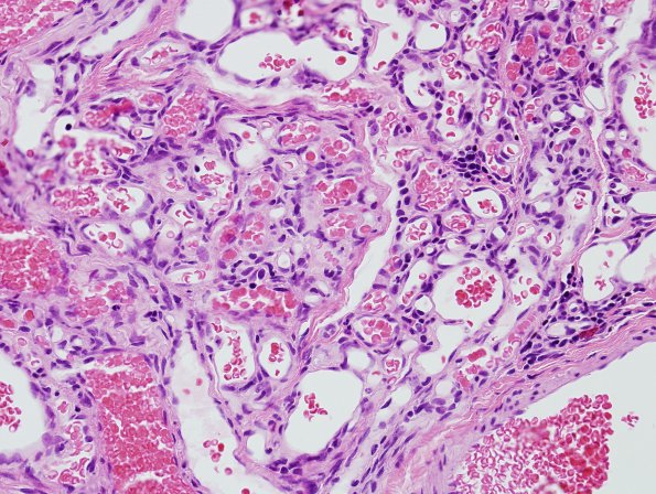 11A2 Hemangioma, capillary (Case 11) H&E 1