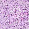 11A3 Hemangioma, capillary (Case 11) H&E 4