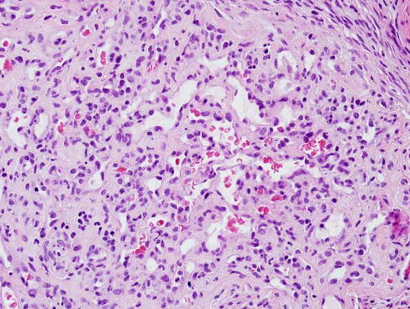 11A3 Hemangioma, capillary (Case 11) H&E 4