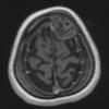 12A1 Hemangioma (Case 12) T1 with contrast - Copy