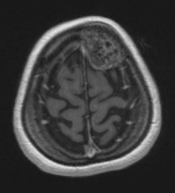 12A1 Hemangioma (Case 12) T1 with contrast - Copy