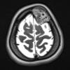 12A2 Hemangioma (Case 12) T2 with contrast - Copy