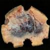 12B1 Hemangioma, cavernous (Case 12)_4