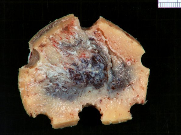 12B1 Hemangioma, cavernous (Case 12)_4