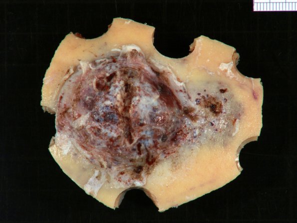 12B2 Hemangioma, cavernous (Case 12)_1