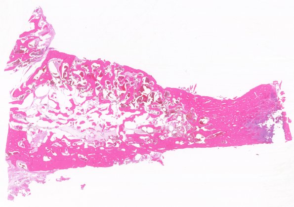 12C1 Hemangioma, cavernous (Case 12) H&E WM 1