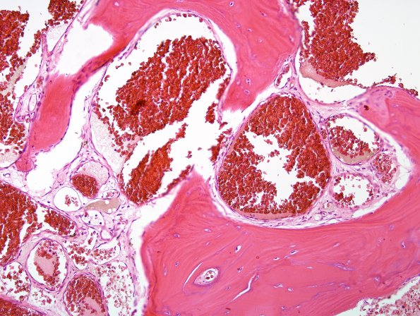 12C5 Hemangioma, cavernous (Case 12) H&E 9