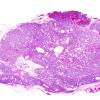 1A1 Hemangioma, Capillary (Case 1)  1